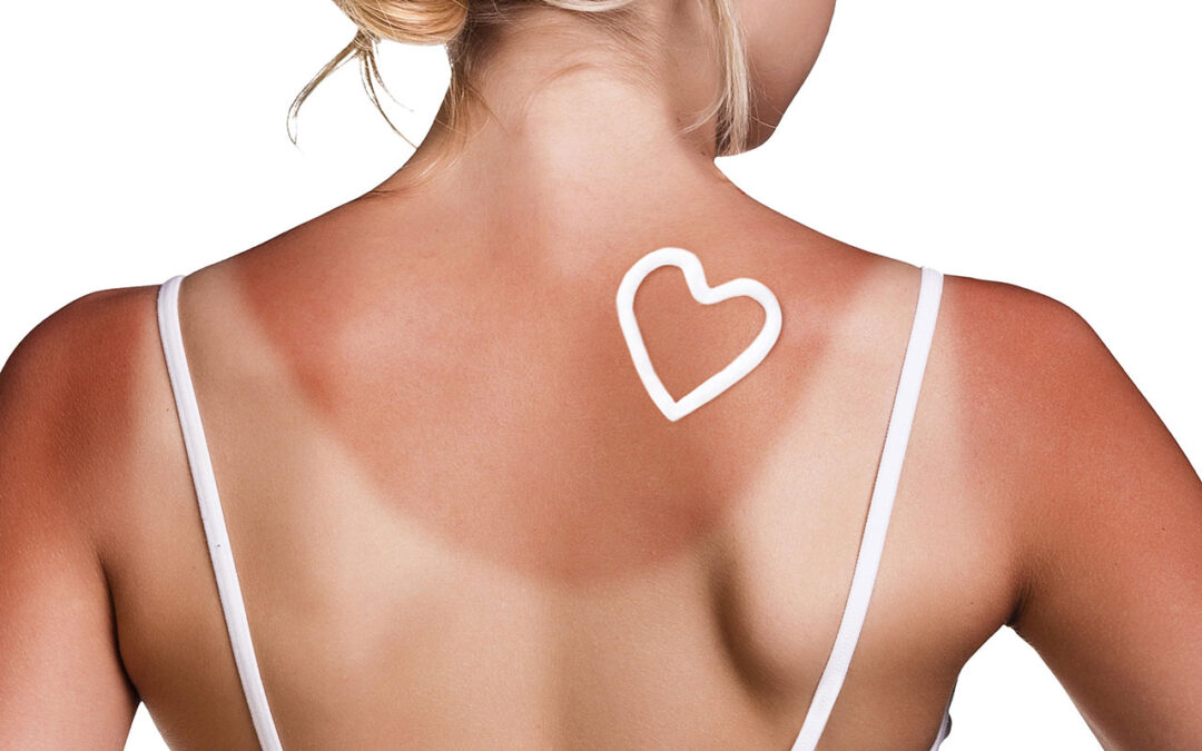 Domowe, naturalne i inne sposoby na oparzenia słoneczne